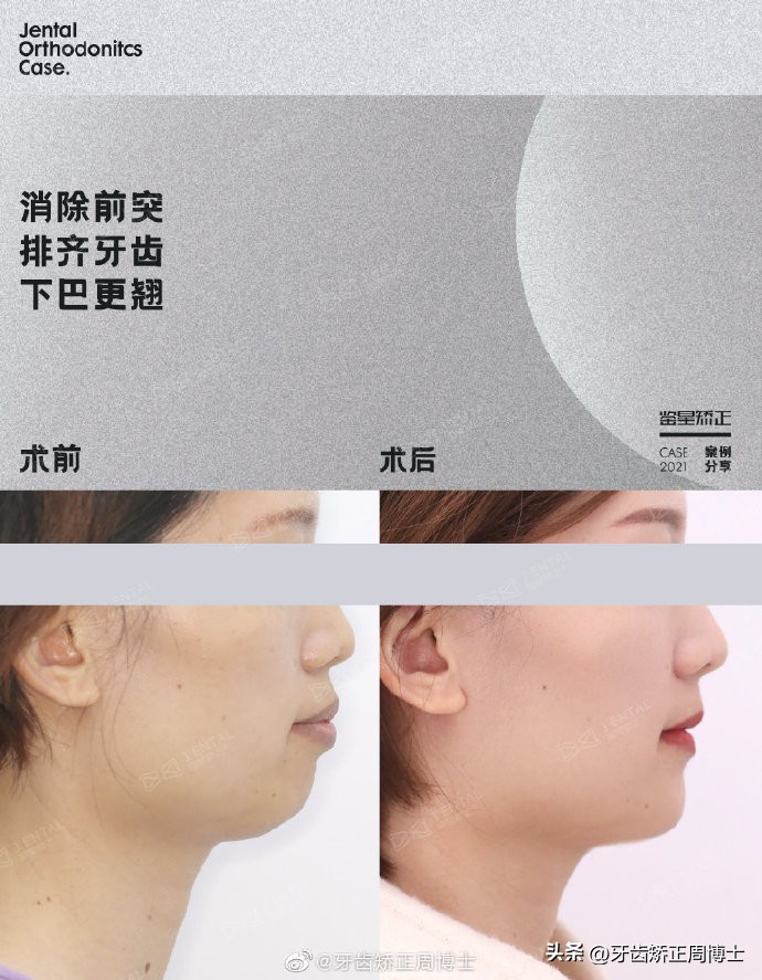 骨性前突正畸后多长时间有效果,牙性下巴后缩可以戴牙套改善吗