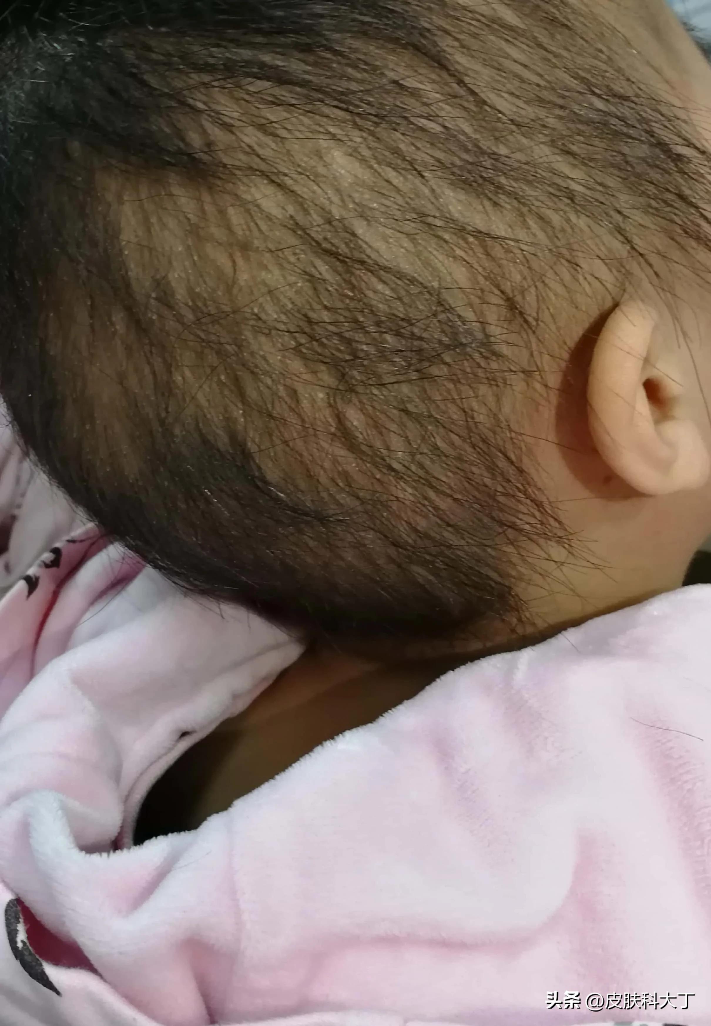 宠物狗容易导致小孩患头癣,因养狗得了癣怎么治