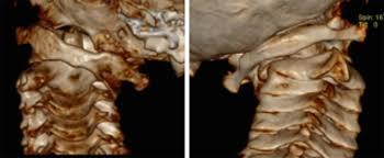 儿童落枕最快恢复办法,落枕了30秒自愈方法儿童