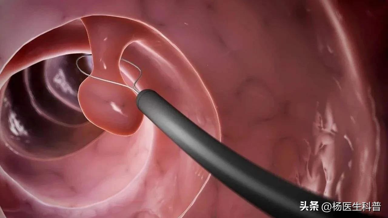 结肠息肉症状和治疗最佳方法,结肠息肉怎么引起来的