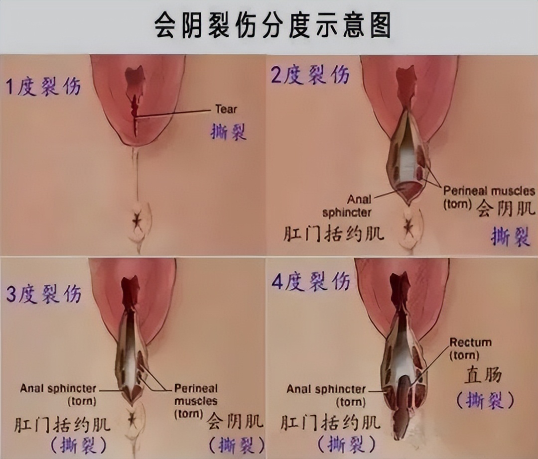 产后会阴裂伤真的像芒果吗,产后裂伤愈合后还会有裂纹嘛