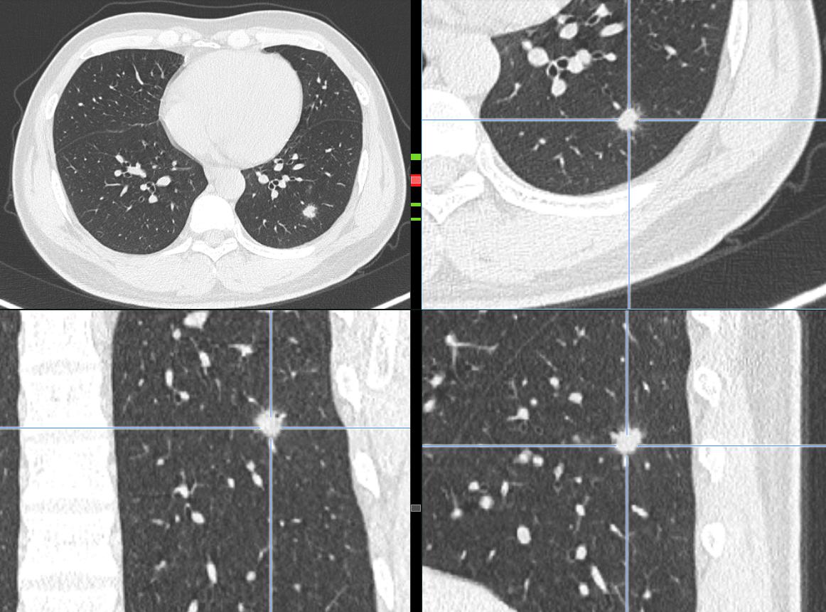 肺结节进一步检查排除肿瘤,肺结节4mm报告建议复查