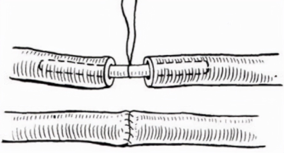 男性什么病要做结扎,男性哪些方面手术是外科手术呢