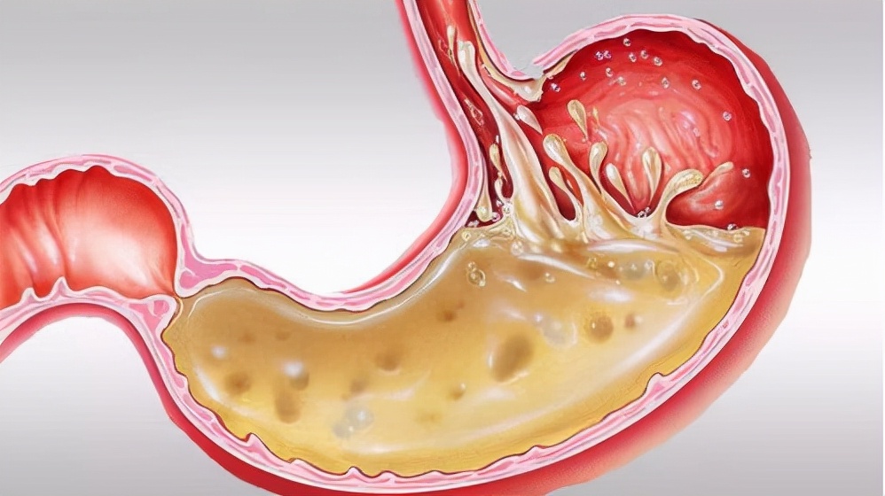 嗓子反流胃酸烧灼痛怎么快速缓解,胃酸反胃吃什么能快速缓解