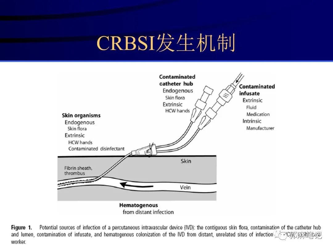 中心静脉穿刺置管术ppt免费,中心静脉置管的护理ppt