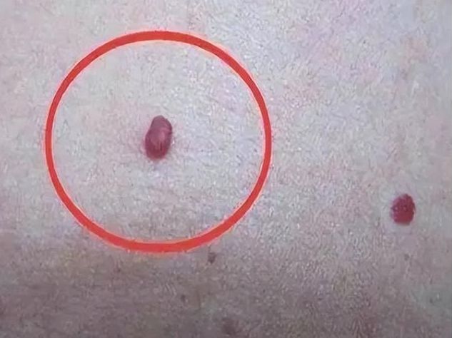 起小红点还特别痒,起小红点是什么病