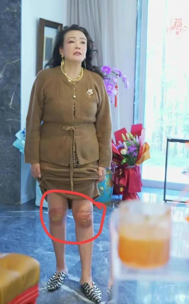 卖惨还是真惨？张兰膝盖红肿流脓不忍直视！