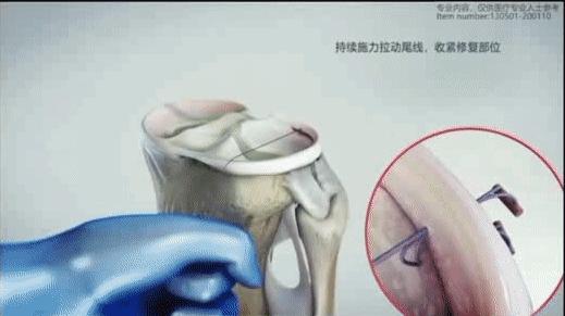 半月板缝合有后遗症吗,半月板缝合后康复训练