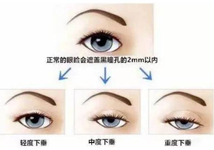 上睑下垂术后眼睑肿抬不起来,上睑下垂眼皮水肿无法抬眼