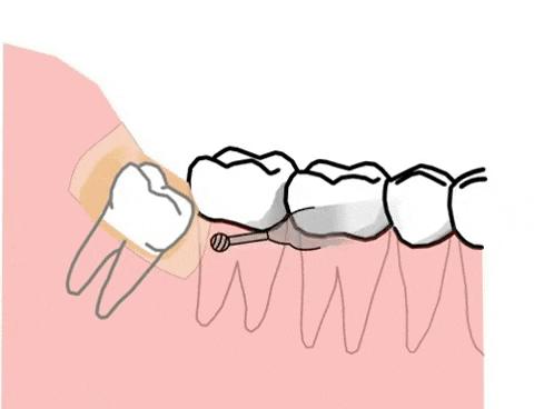 牙齿长小牙该怎么拔掉,牙齿长在上颌窦里了能拔吗