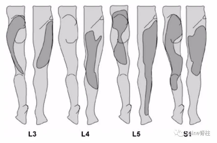 腰椎间盘突出症状表现,腰椎间盘突出症疼痛最佳止痛方法
