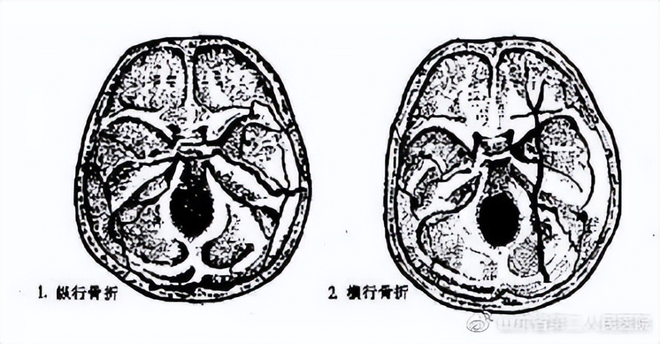 外伤引起的面瘫最快恢复方法,外伤造成的面瘫