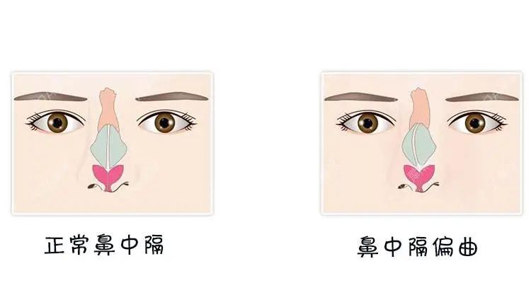 没感冒鼻子不通气是什么原因,鼻子不通气冒火什么原因引起