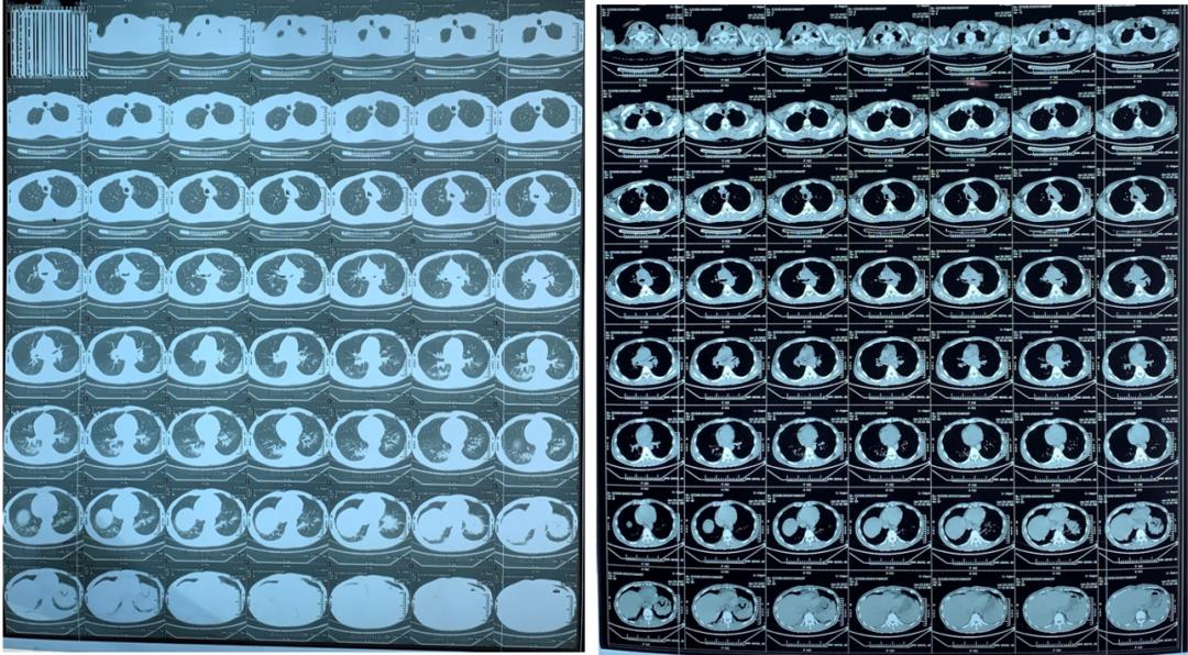 男23岁因上呼吸道感染剧烈咳嗽,34岁小伙咳嗽一个星期了