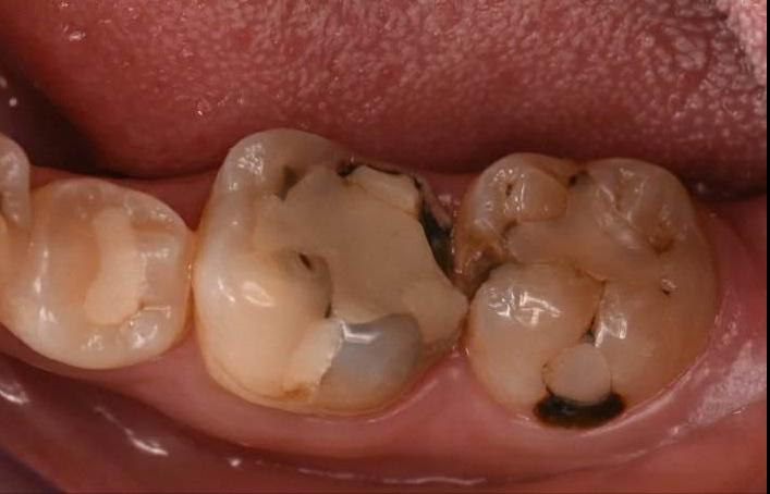 烂牙旁边有洞的正确治疗方法,为什么烂牙要钻洞