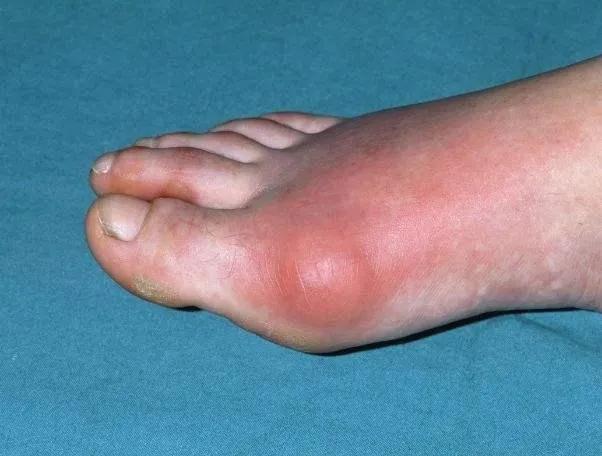 男性痛风饮食上应该注意些什么,右脚大拇指痛风饮食注意什么