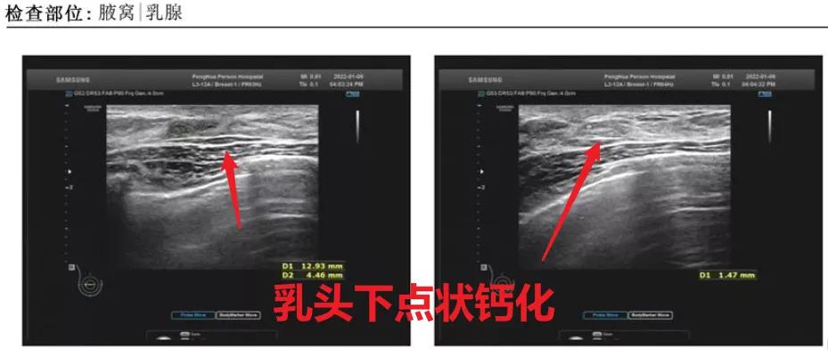 联合检查达到的效果,合并导管原位癌