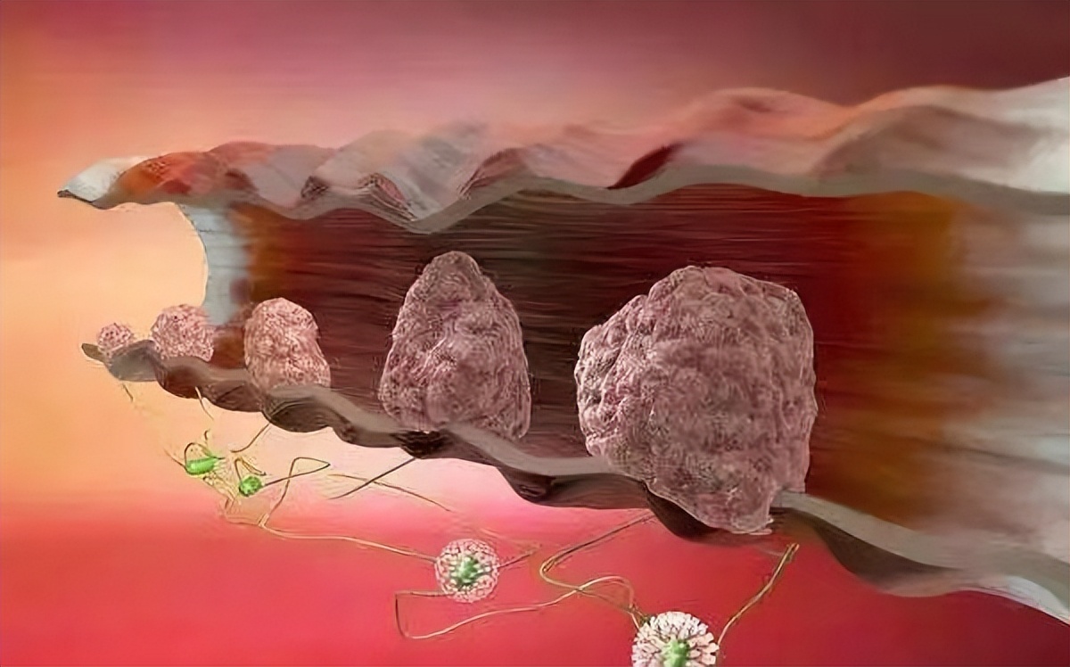 胆囊息肉吃去胆汁的药有用吗,中医调治胆囊息肉