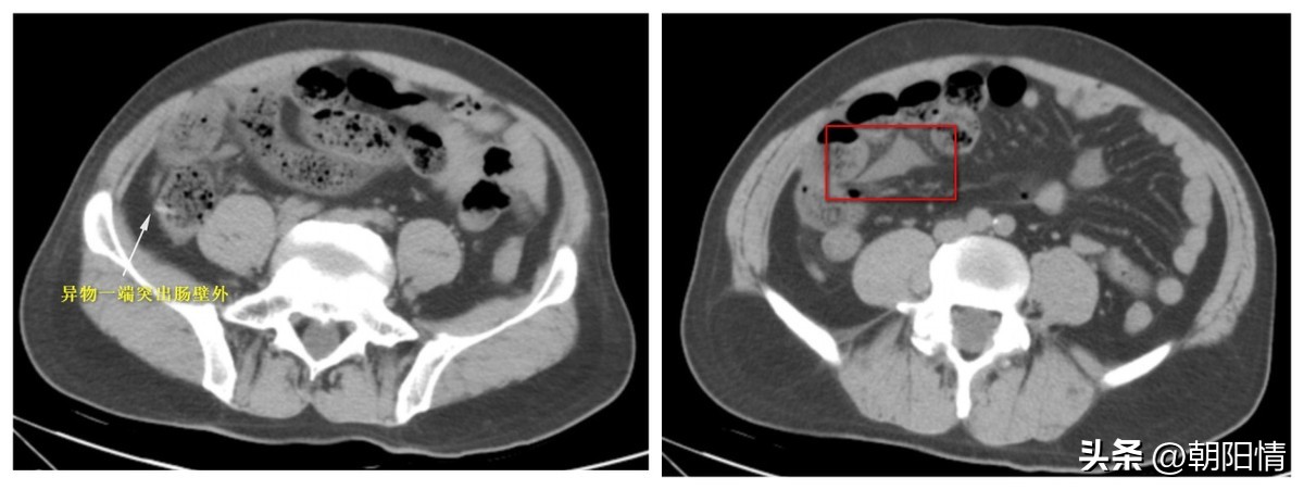 消化道异物中医诊断名称,消化道骨性异物
