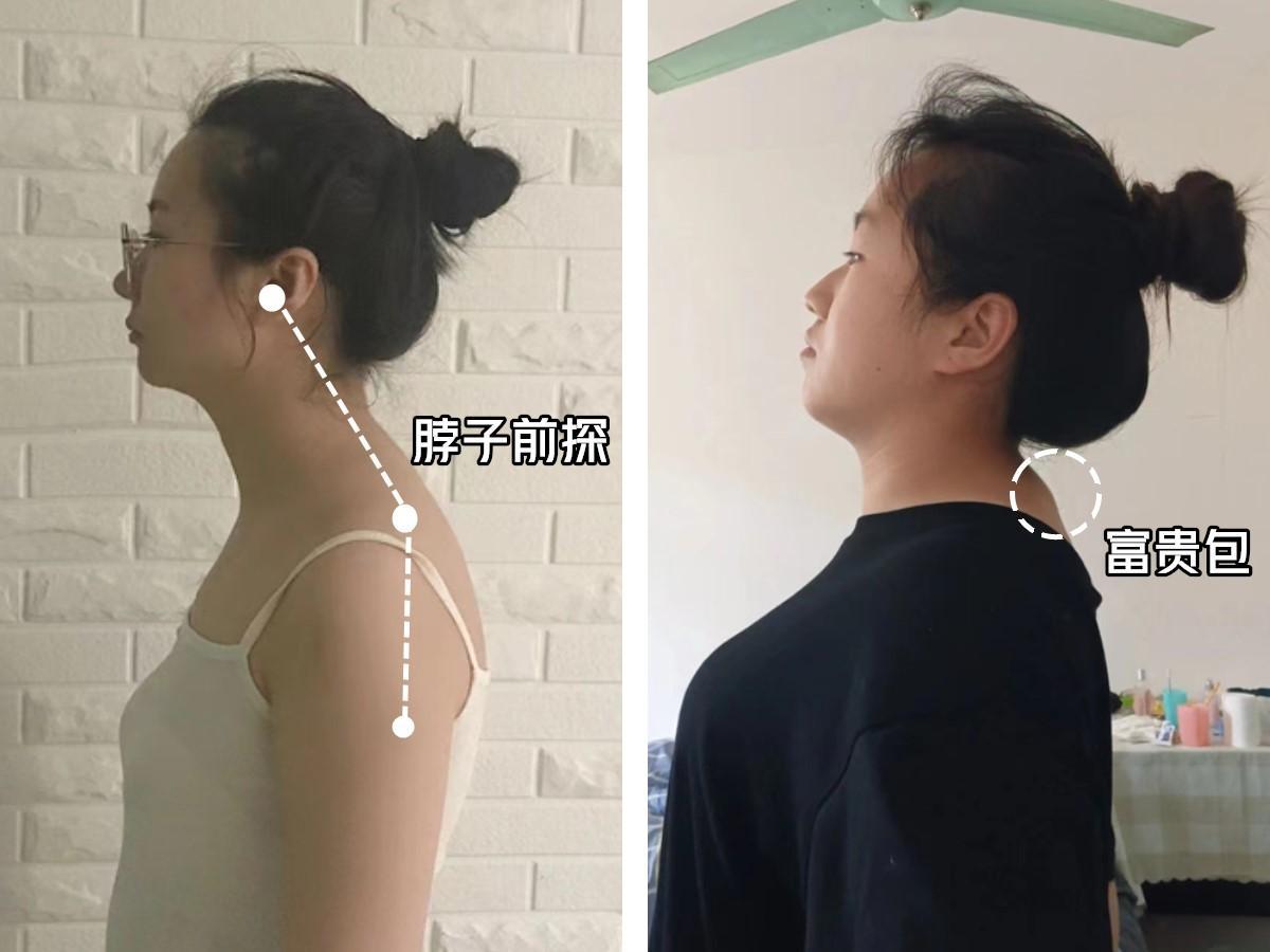 富贵包真的很丑吗,有富贵包会影响寿命吗