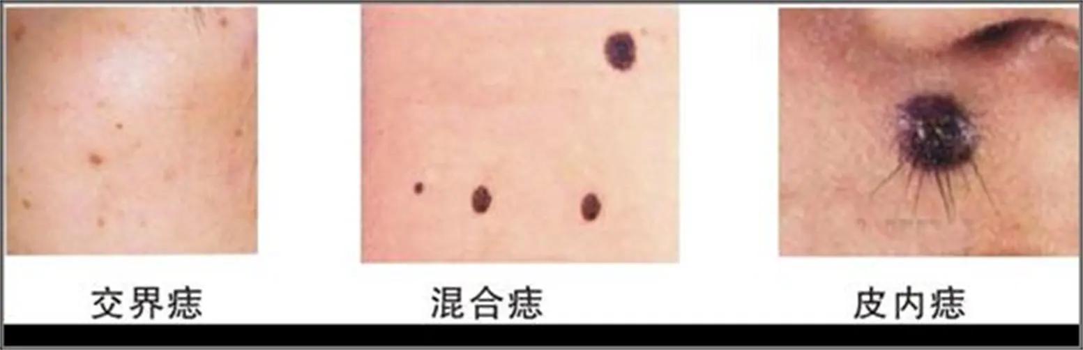 你是否众“痣”成城？跟我一起专心致“痣”