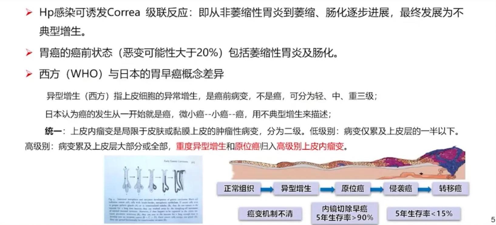 胃早癌食管早癌会复发吗,胃早癌与进展期癌怎么区分