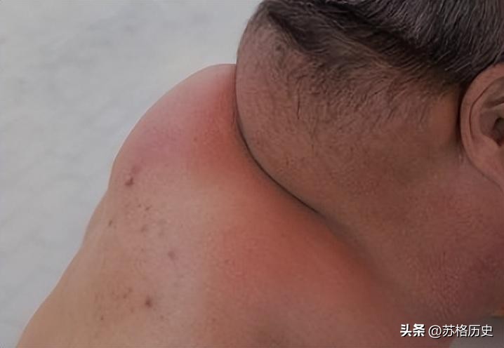 喝了40年酒结果变成河马脖,喝白酒脖子变成河马脖