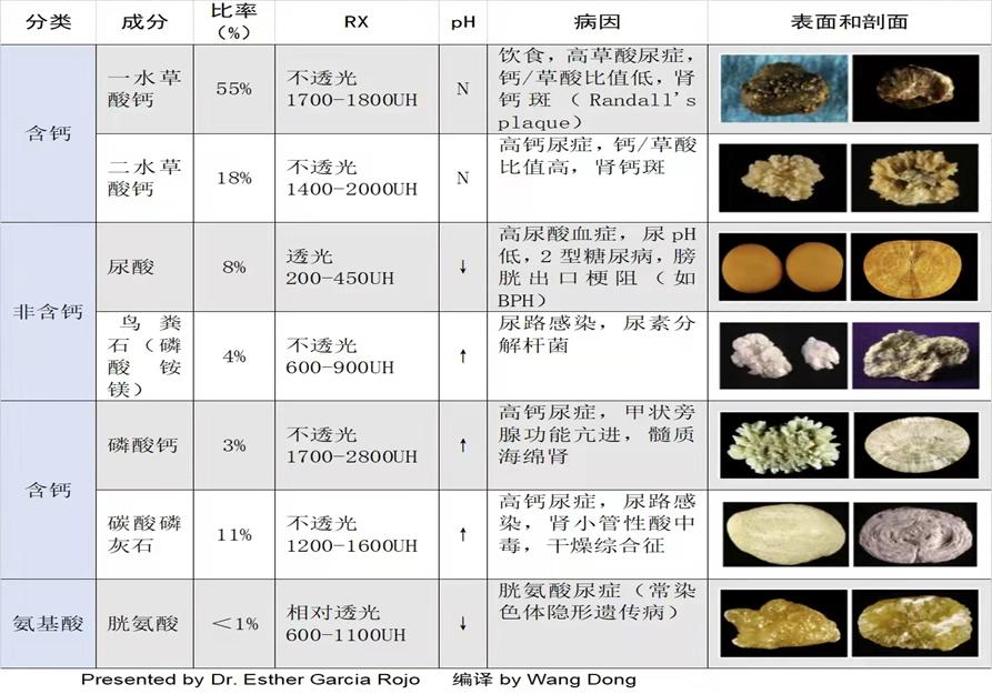 人体结石如何去除,人体结石怎么消除最好的方法