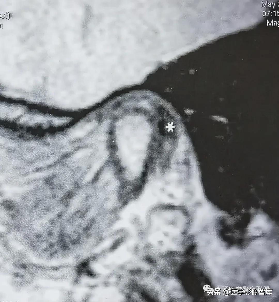 颞下颌关节移位怎么处理,颞下颌关节盘变形怎么治疗