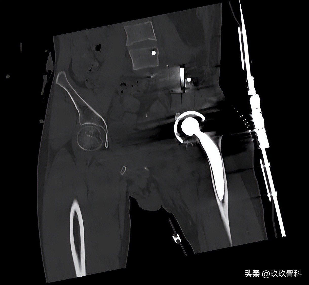 力达康定制型模块化假体治疗“肿瘤切除术后半骨盆缺损”
