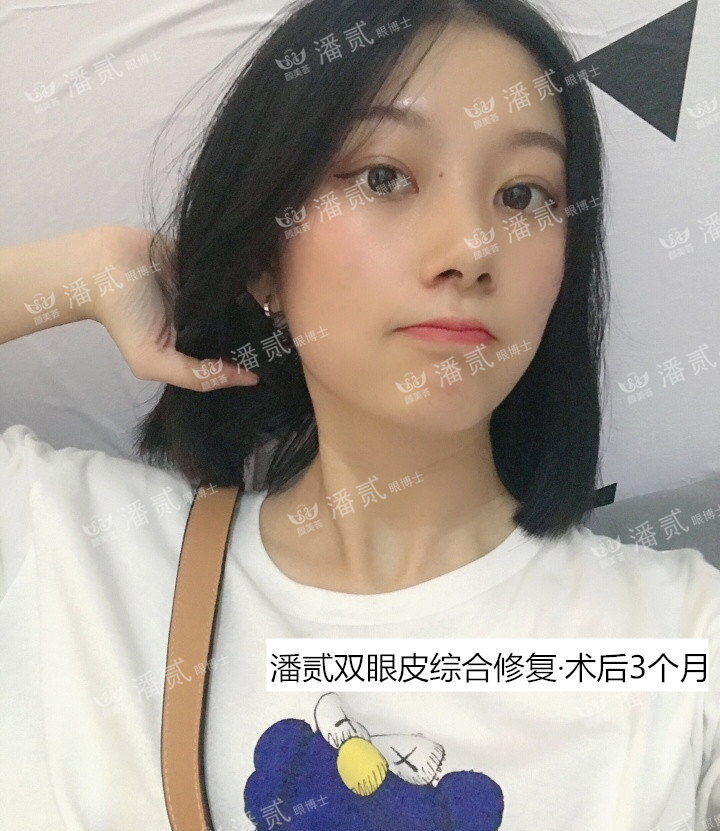 双眼皮贴导致眼皮破了,双眼皮贴导致眼皮严重下垂恢复