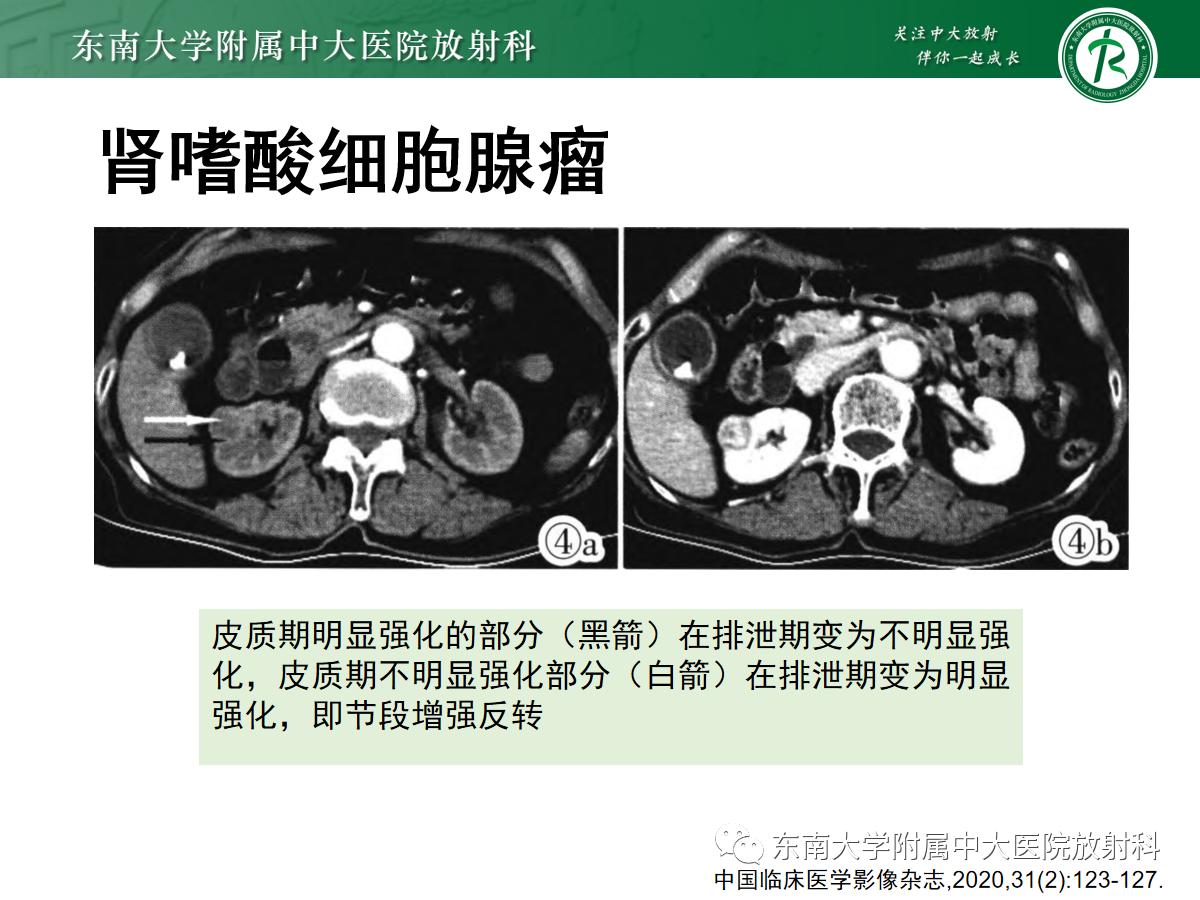 周利群谈肾嫌色细胞癌ct特点,好文分享值得深思
