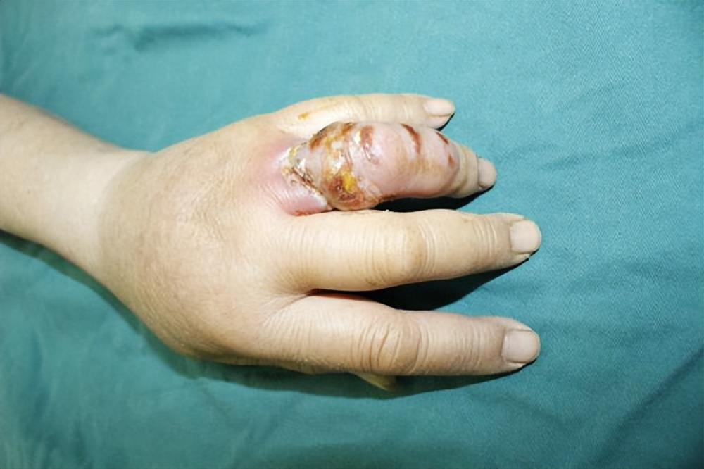 手指被小龙虾夹伤怎么办,手指被小龙虾扎了怎么办