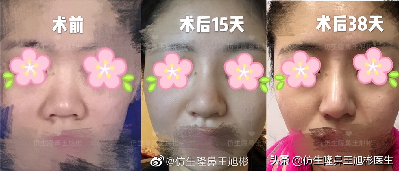 可以只做鼻头不放假体吗,只做鼻头鼻翼缩小手术多少钱