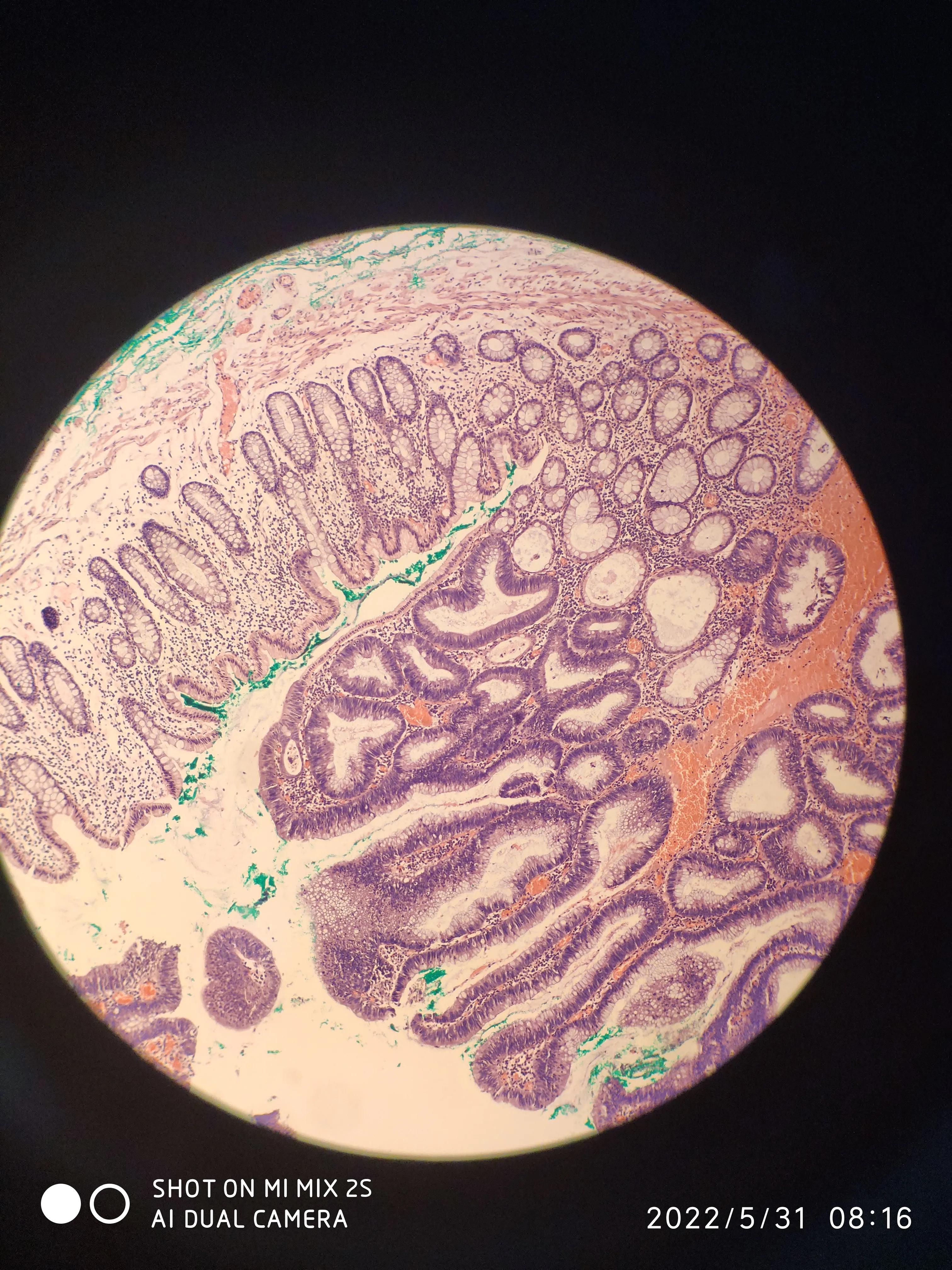 esd手术后续身体感觉,esd手术可靠吗