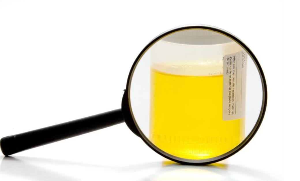 小便泡沫多和肾有什么关系,尿尿泡沫多是肾阴虚还是肾阳虚