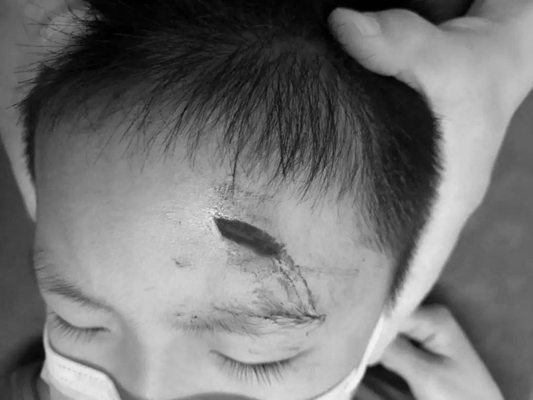 受伤后千万不要抠结痂,受伤了希望不要留下疤痕