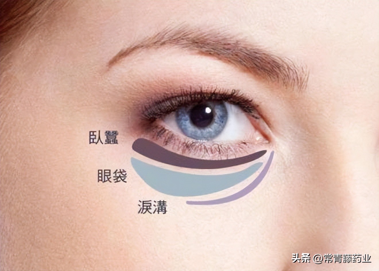 怎样预防缓解泪沟和眼袋,眼袋泪沟的原因及解决方法