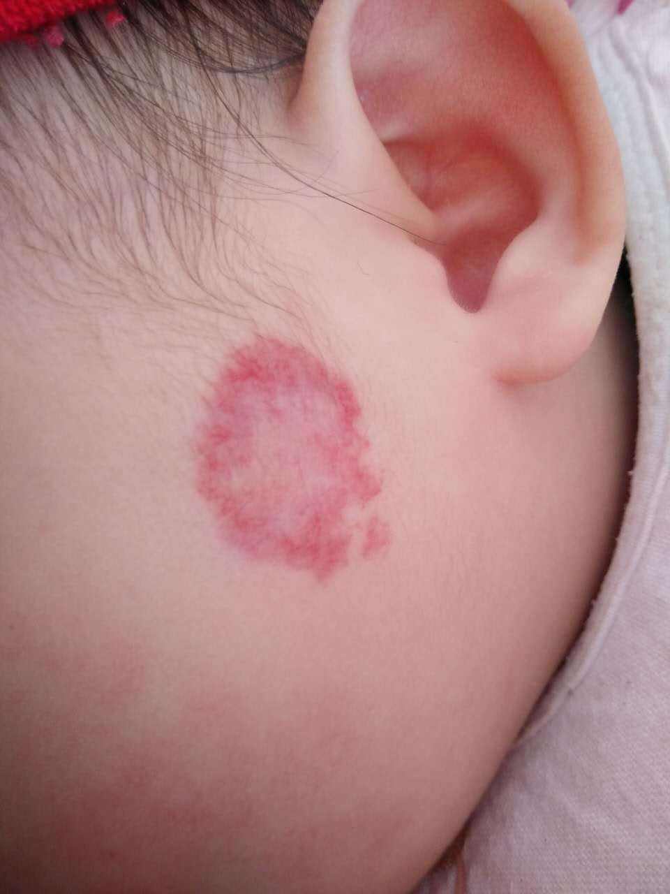 宝宝身上的记号,宝宝身上的小点点密密麻麻很淡