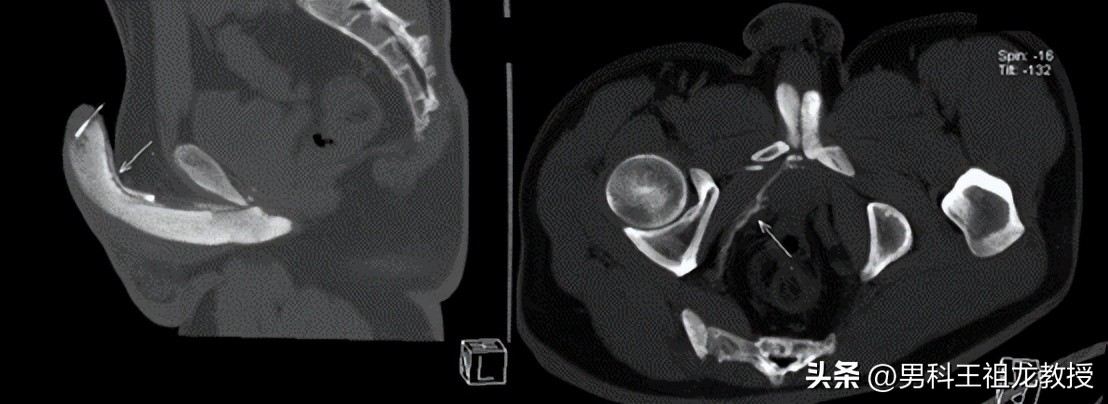 我院男科，完成首例CT下阴茎海绵体造影及三维血管重建手术！