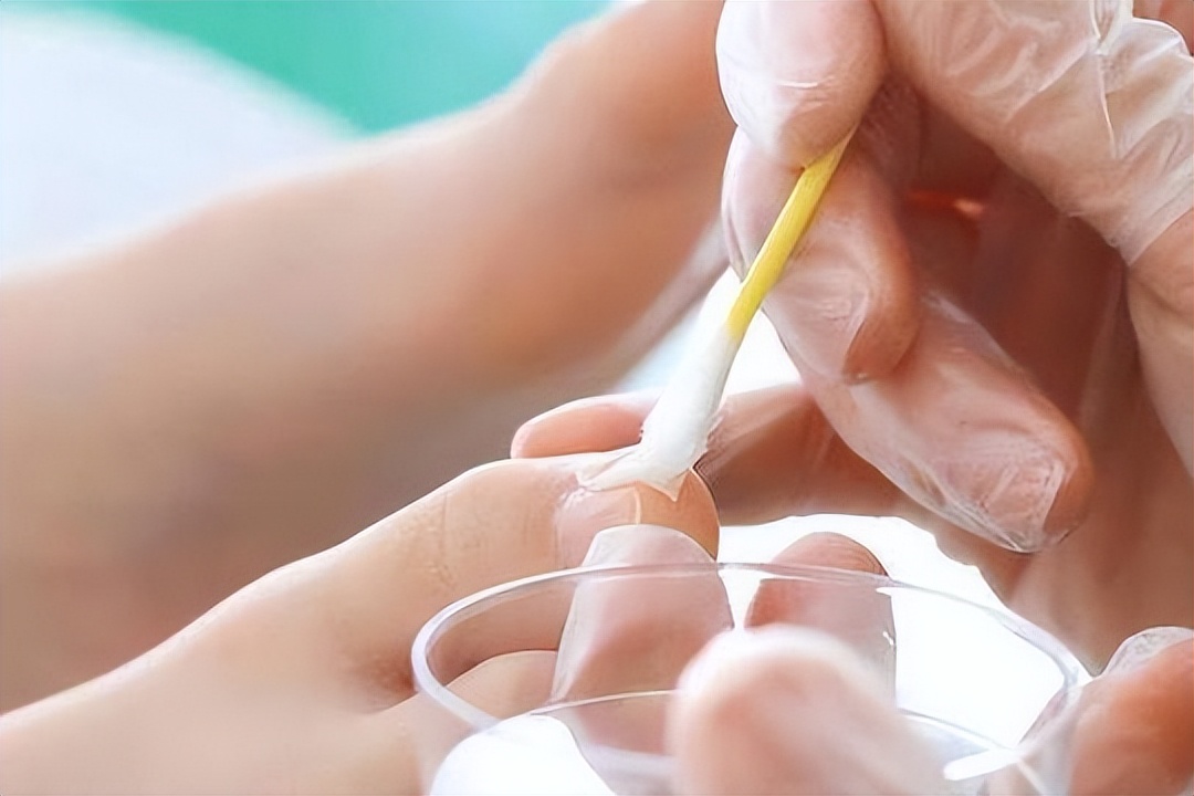 灰指甲治愈心得分享,分享自己根治灰指甲