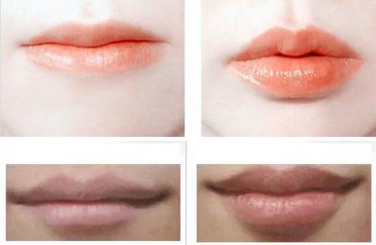 玻尿酸丰嘴方法,玻尿酸丰唇怎么做减龄