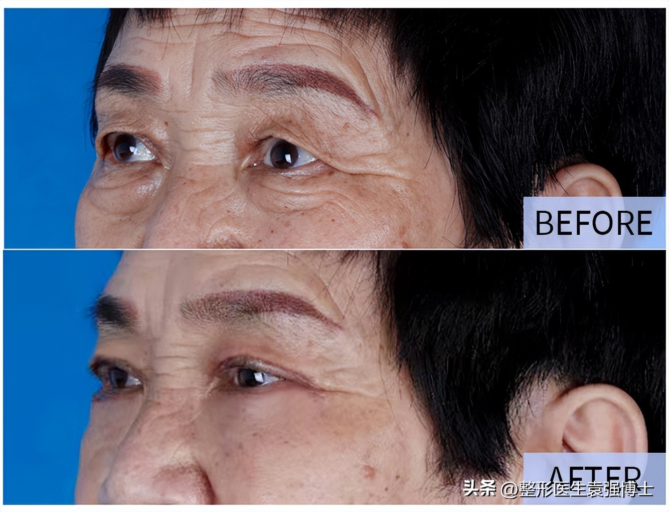 上眼皮松下垂该怎么办,上眼皮松弛耷拉怎么办