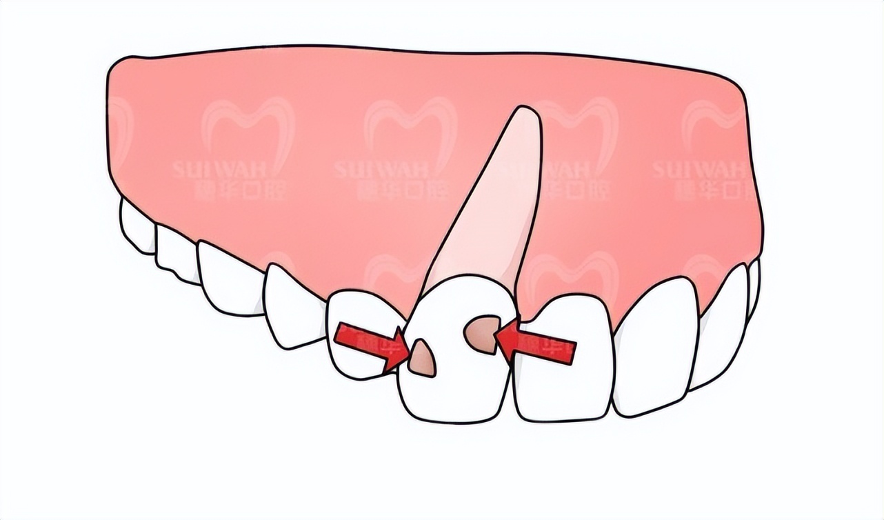 疫情期间，牙疼、牙套丢了怎么办？暨南大学穗华口腔专家在线支招