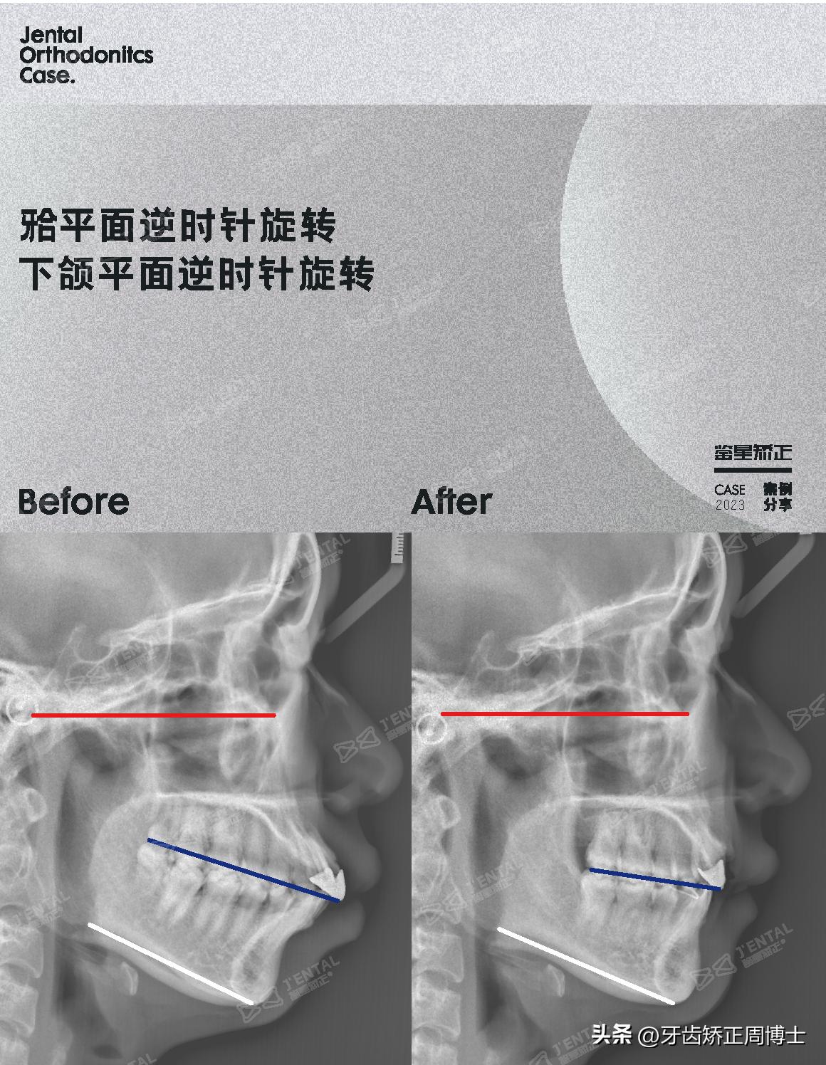 骨性上颌前凸嘴怎么矫正,厚嘴唇与嘴凸有关吗