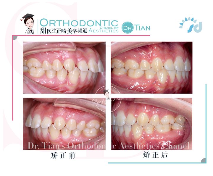 凸嘴下巴后缩拔牙改善有什么坏处,深覆合嘴凸下巴后缩矫正要拔牙吗