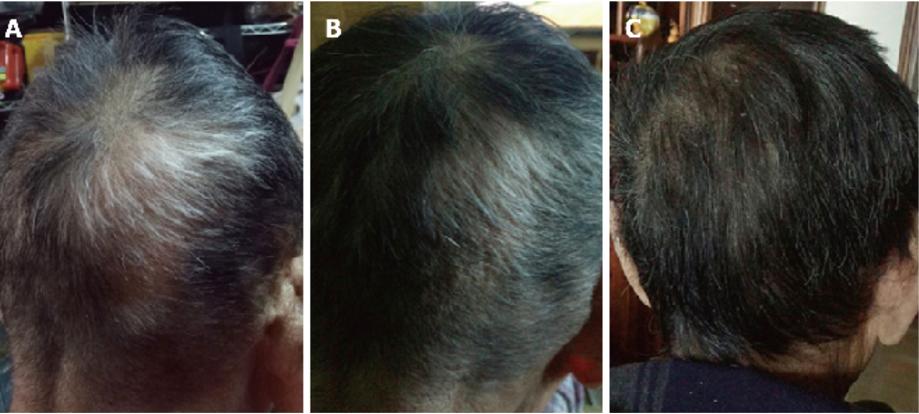 粪菌移植改善多种疾病,粪菌移植治疗肝性脑病