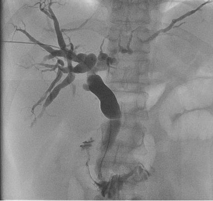介入穿刺全过程,介入穿刺技术