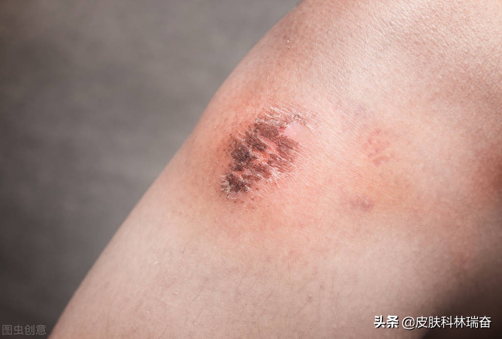 8种消除疤痕的自然方法,处理疤痕最好的方法