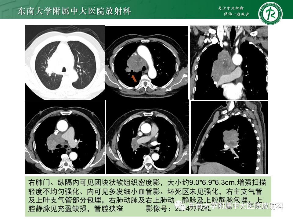 好文分享值得深思,纵隔精原细胞瘤